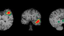 CHUSJ usa IA para apoio na interpretação de imagens cerebrais