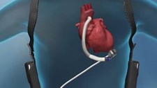Hospital de Coimbra implantou o seu primeiro ‘coração artificial’