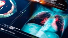 Investigação testa técnica no âmbito do tratamento do cancro do pulmão