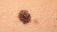 Lusíadas Saúde promove consulta de avaliação do melanoma