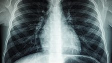 Especialistas alertam para diagnóstico precoce no cancro do pulmão