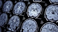 Identificar biomarcadores para ajudar a parar convulsões