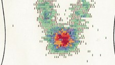 Medicina Nuclear Clínica: A história no mundo e em Portugal